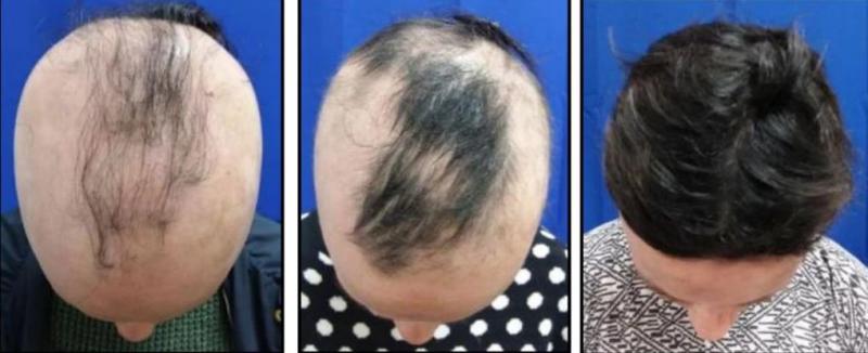 Fármaco experimental para tratar alopecia obtiene buenos resultados: se podría recuperar más del 80% del cabello