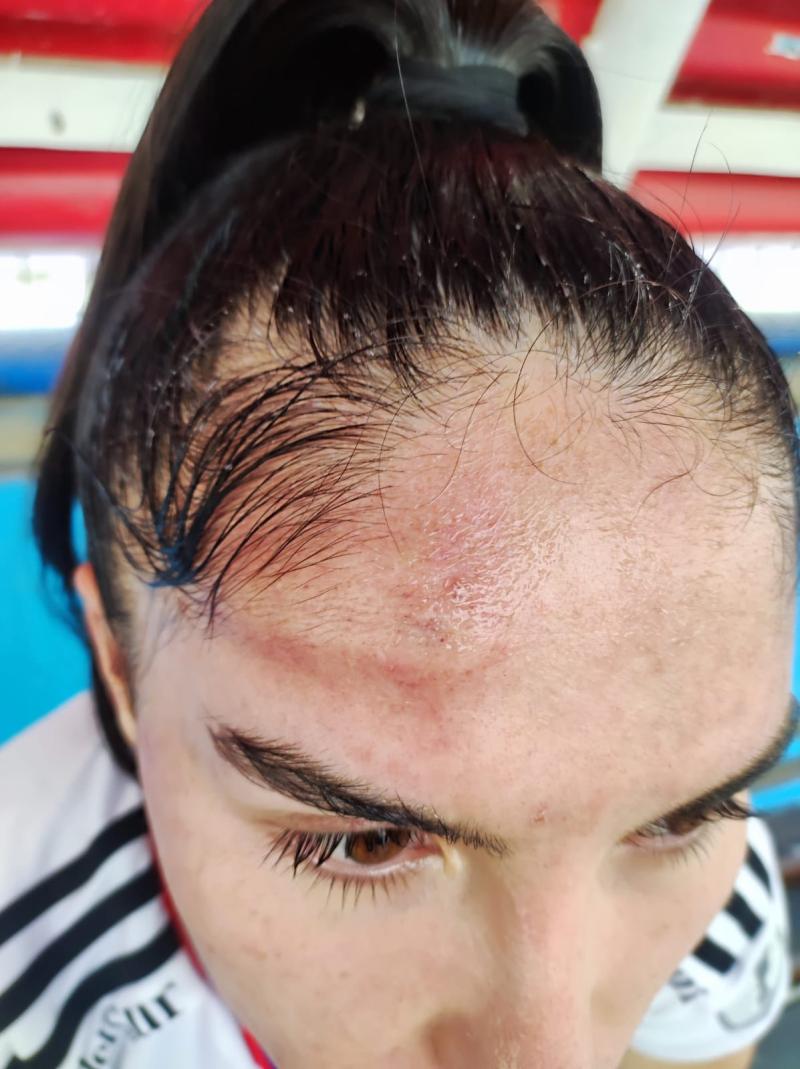 Así quedó Javiera Grez tras la brutal patada ante Deportes Antofagasta.