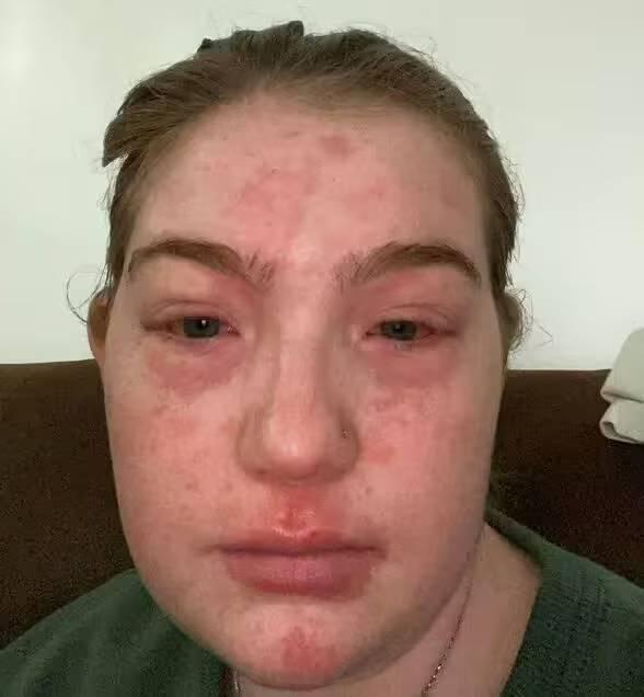 Virginia Nault - alergia - Tiktok