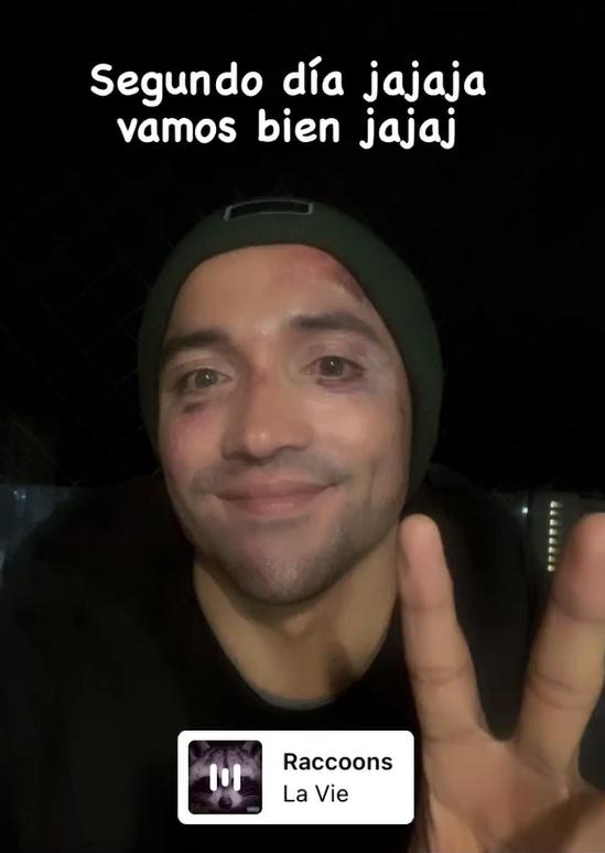 Miguel Pinto mostró las heridas en su rostro tras fuerte impacto - Créditos: Captura Instagram