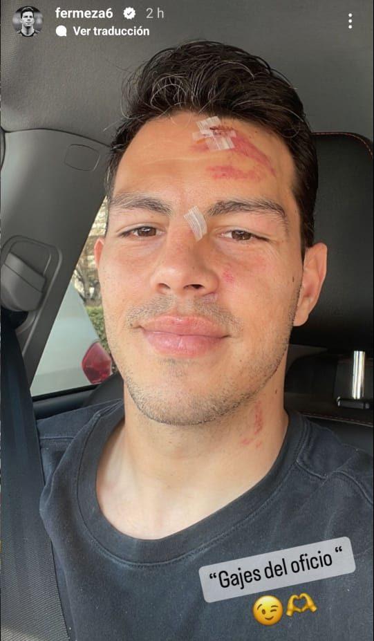 Fernando Meza mostró las heridas en su cara. Imagen: Instagram.
