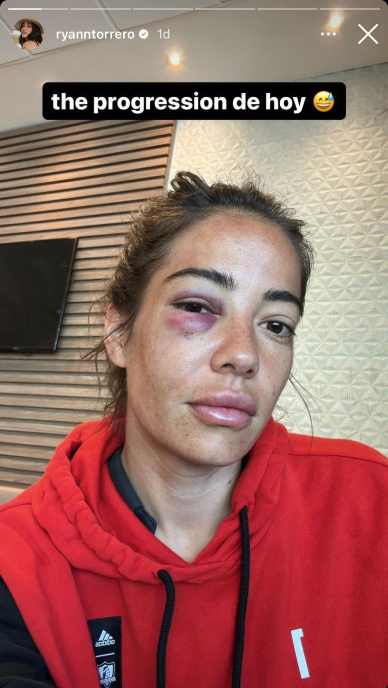La portera de Colo Colo compartió el estado de su ojo - Créditos: Intagram Ryann Torrero