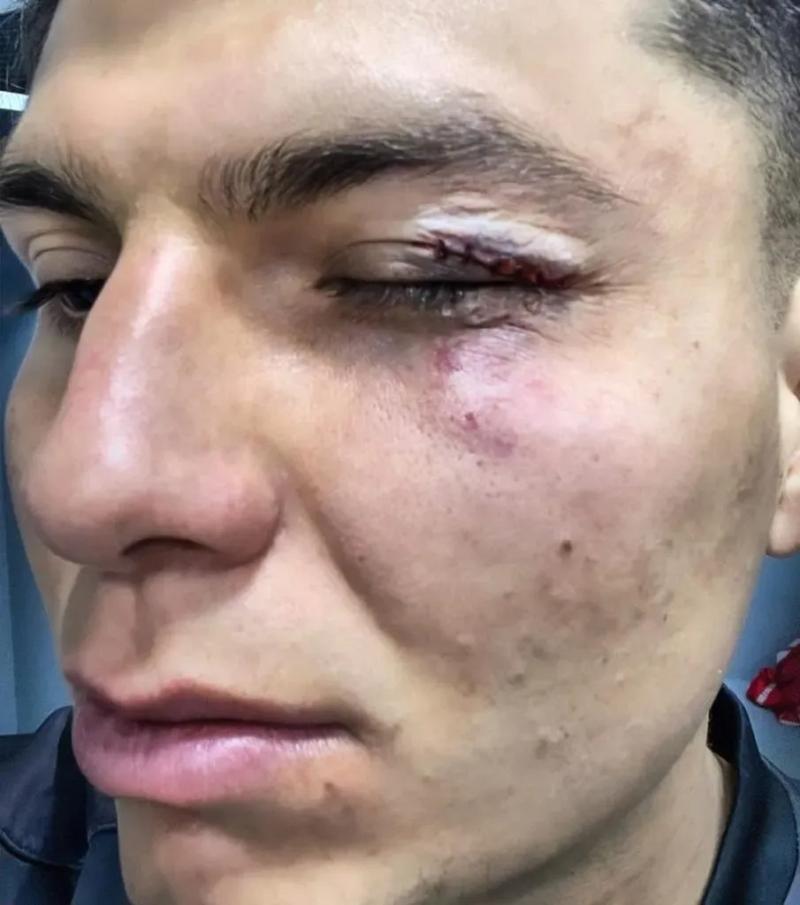 Raimundo Rebolledo recibió un brutal golpe en duelo de Ñublense y LDU de Quito. / Foto: Instagram