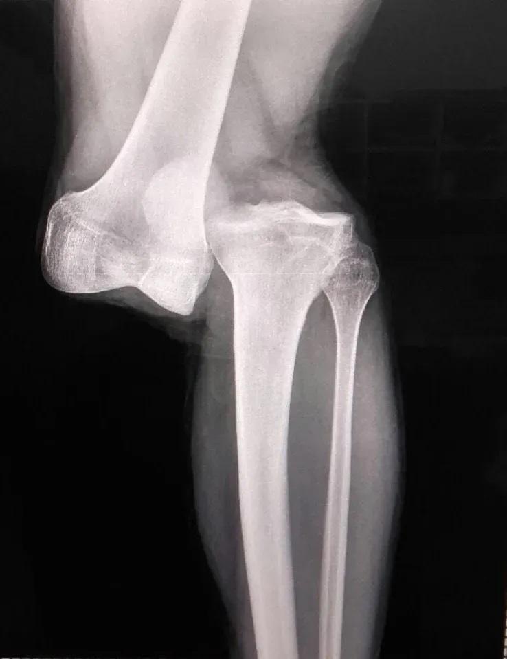 La radiografía de la lesión de Luciano Sánchez - Créditos: Archivo.