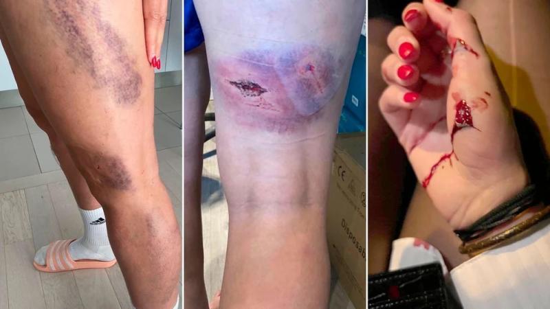 Así quedaron las piernas de Kheira Hamraoui - Créditos: Instagram