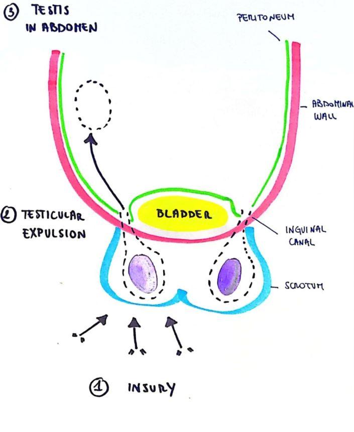 (BMJ Case Reports 2023) Dibujo hecho por los investigadores del caso mostrando dónde terminó el testículo del paciente