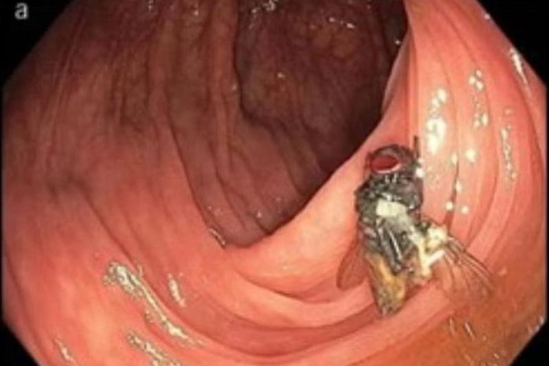 American Journal of Gastroenterology - Mosca en un intestino