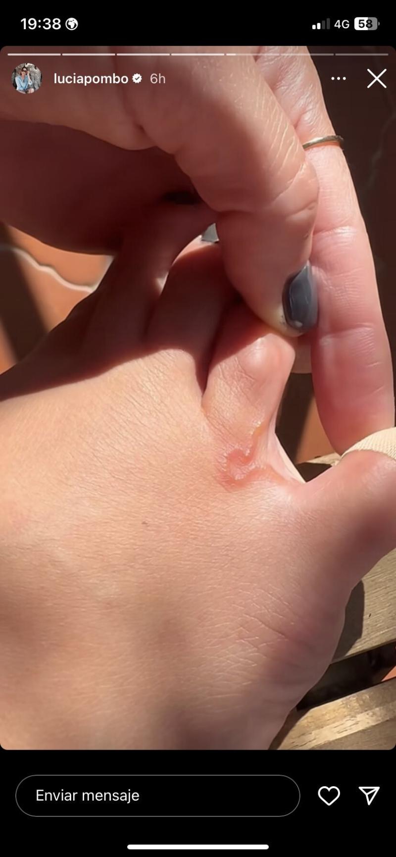 Instagram - Influencer tiene gusano en su interior.