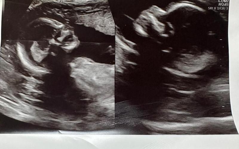 Ecografía de los embarazos en cada uno de los úteros