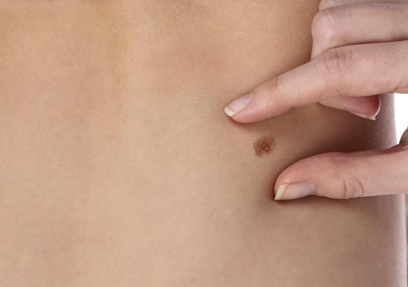 operativo de chequeo de lunares gratuito