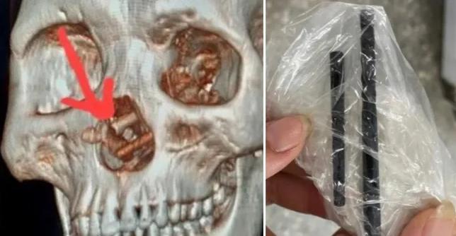 ietnam Cuba Hospital - Sufría dolores de cabeza: hombre tenía palillos chinos en el cerebro