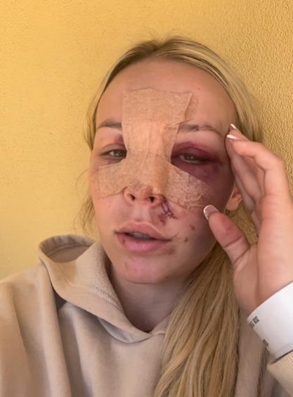 Taylah McCutcheon sufrió un escalofriante accidente - Crédito: Instagram @taylah10_