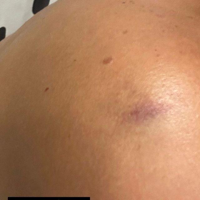 Las imágenes de la herida de Faloon / Instagram