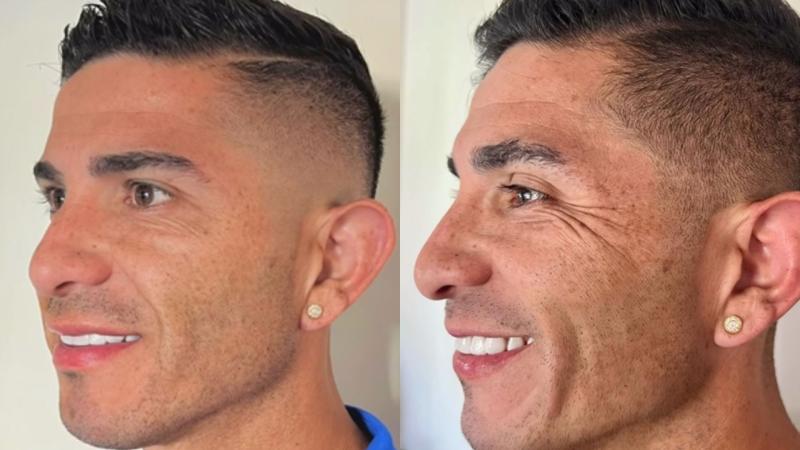 El antes y después de Felipe Flores / Clínica Clarp Estética