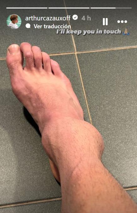 Así quedó el pie de Arthur Cazaux - Crédito: Instagram @arthurcazauxoff