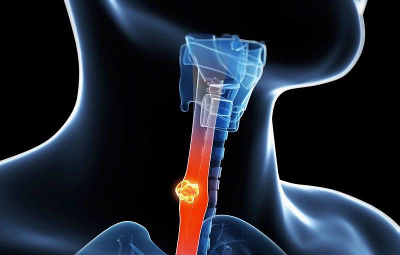 Cáncer de esófago afecta mayoritariamente a hombres - Referencial pexels.com