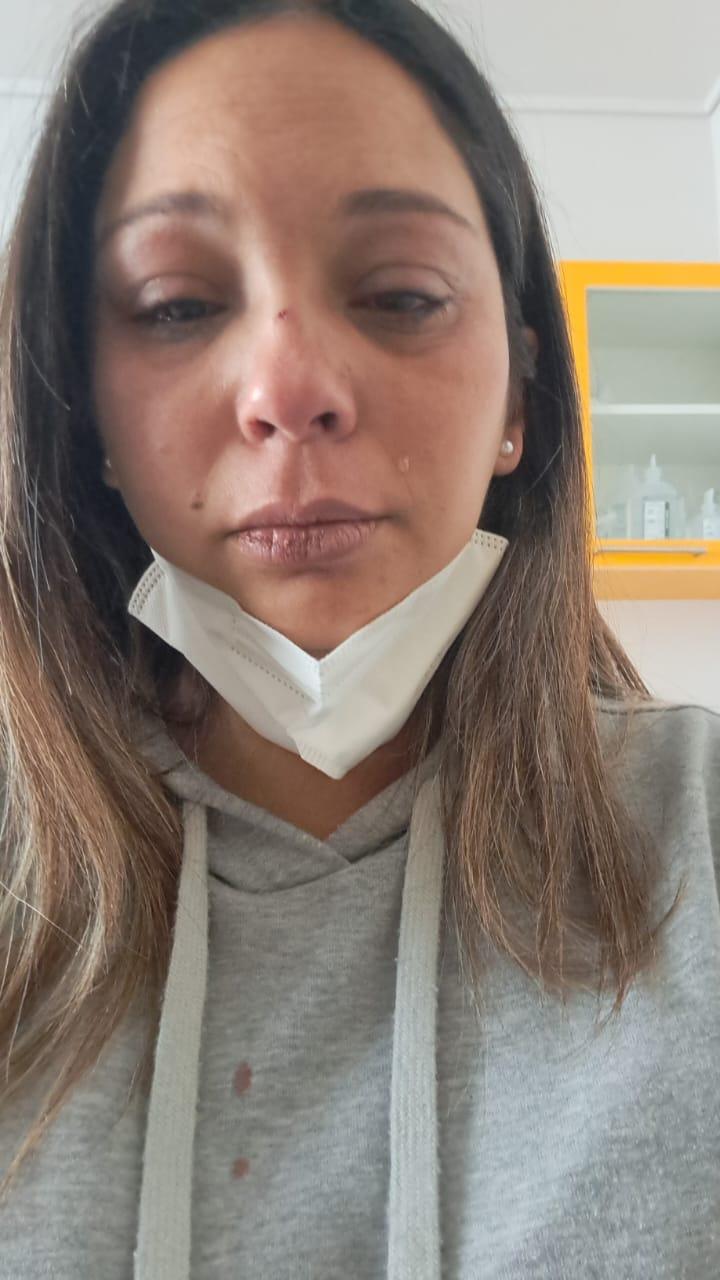 Mujer fue golpeada en el rostro por un hombre en Concón La esposa del agresor la había chocado