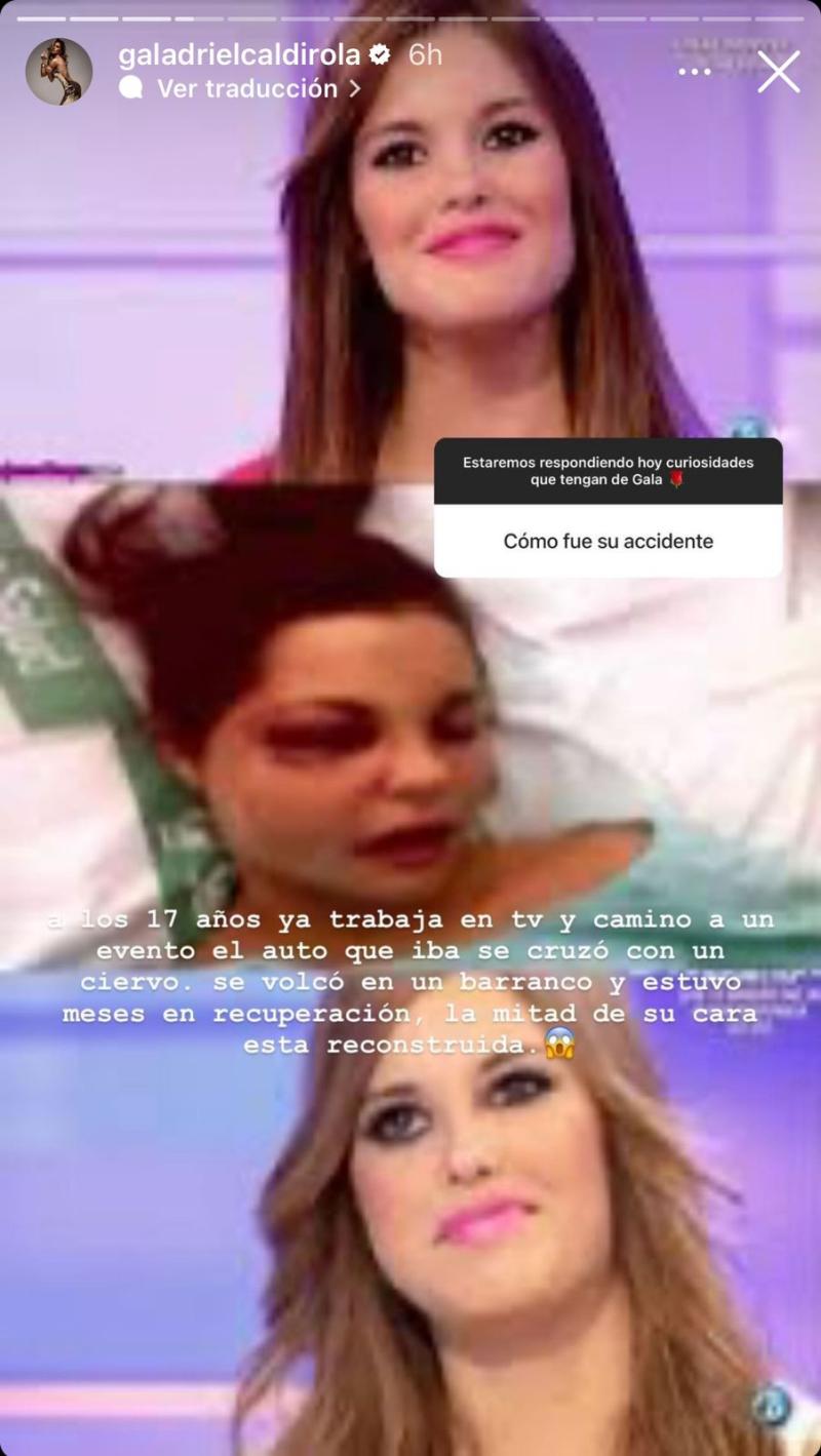 Instagram - Rostro de Gala Caldirola antes y después del accidente