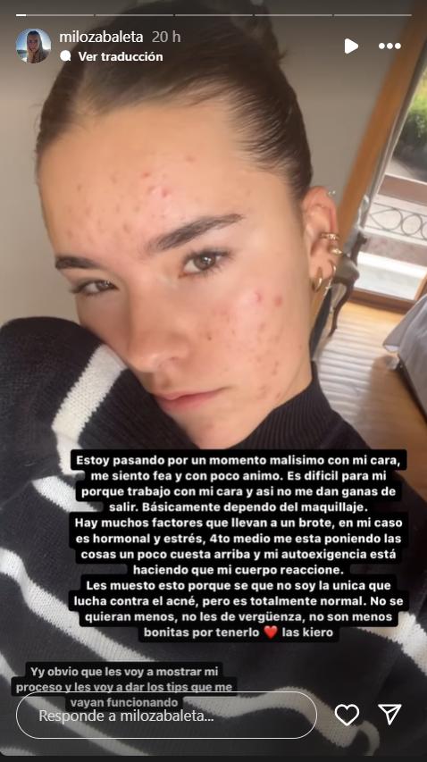 Milagros Zabaleta mostró los efectos del acné en su rostro - Instagram