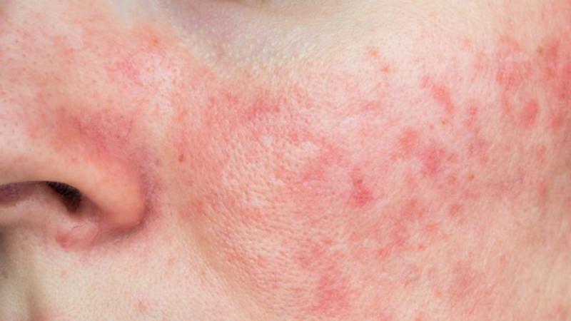 Virus de la bofetada - Referencial pexels.com