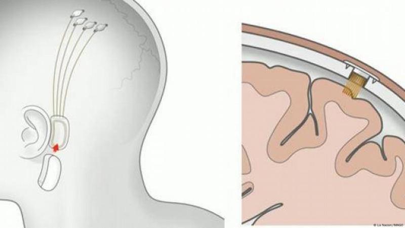Deutsche Welle - Elon Musk - Representación de la instalación del chip Neuralink en el cerebro humano.