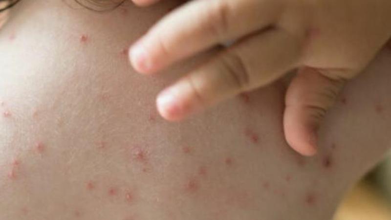 OMS preocupada por una nueva cepa de la 'viruela del mono' - pexels.com