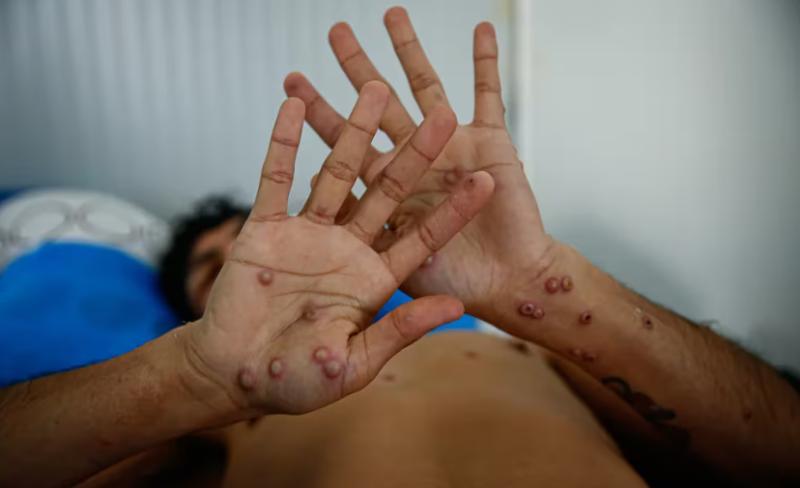 Europa Press - ¿Cómo vacunarme contra la viruela del mono en Chile?