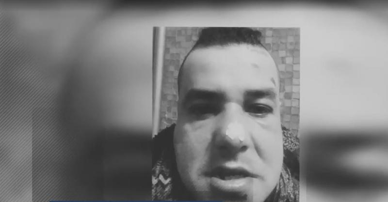 T13 - Hombre denuncia brutal golpiza en Linares