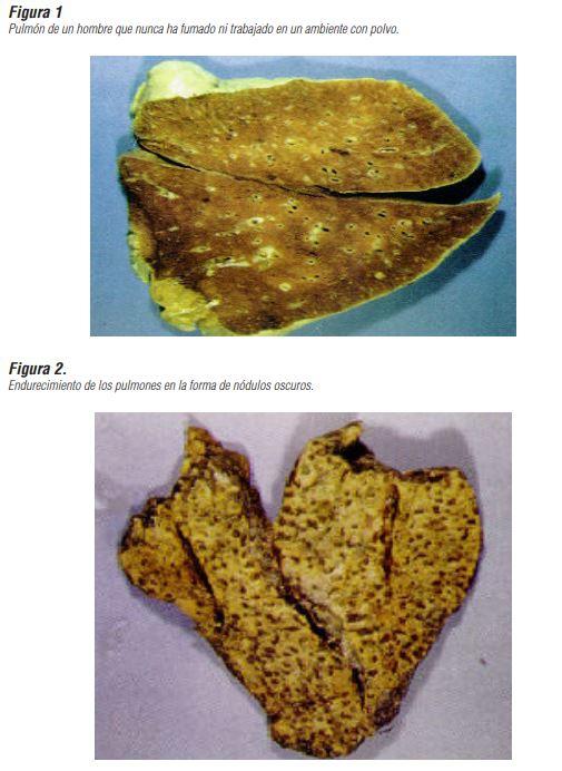 ISP - Comparación de pulmón sano con uno con nódulos