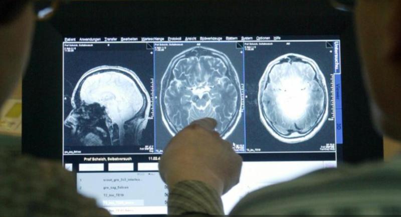 AFP - Nuevos tratamientos contra el alzheimer: ¿revolución o ilusión?