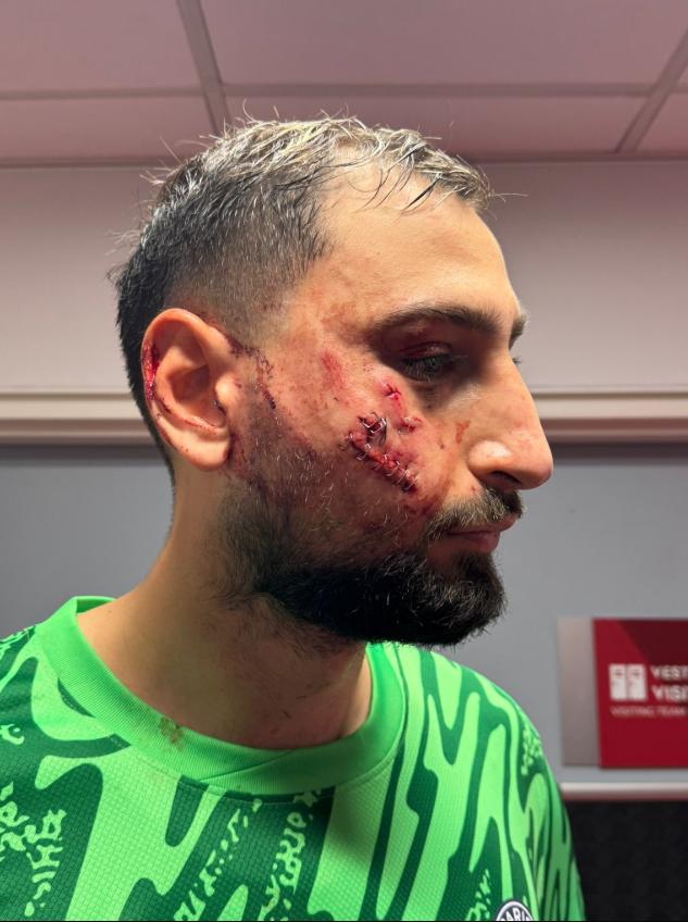 Así quedó el rostro de Gianluigi Donnarumma - Créditos: @ArthurPerrot