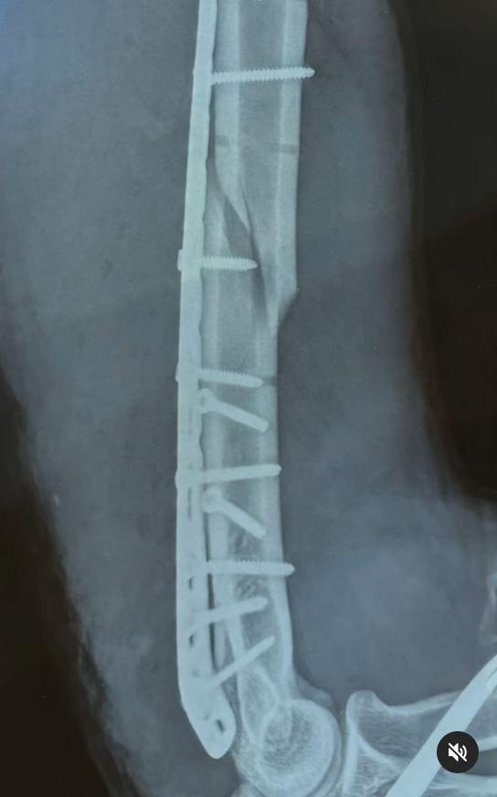 El joven sufría la fractura de su brazo derecho mientras jugaba a las vencidas, conocido como "gallito" en Chile.