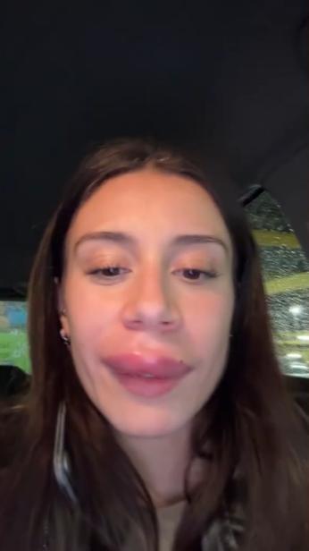 Joven advierte sobre el uso del ácido hialurónico: "Aseguraos de ir a una clínica decente"