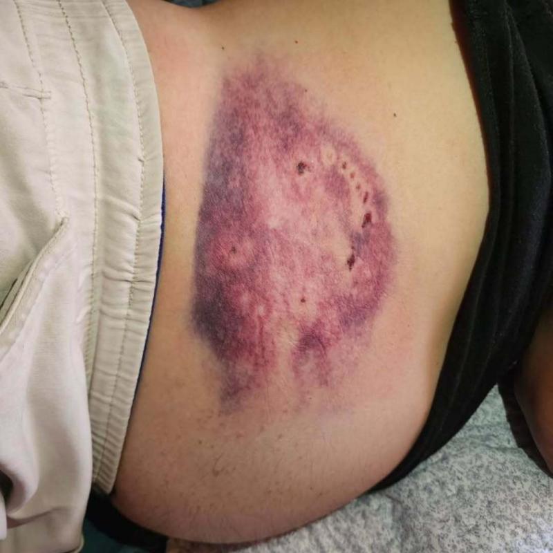 Así estaba la herida del padre de Cindy Nahuelcoy - Créditos: @primerafuente