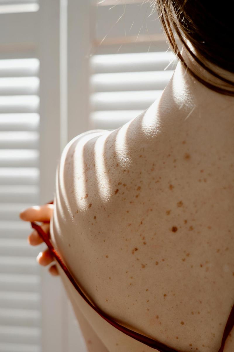 Daños por quemaduras en la piel - Pexels