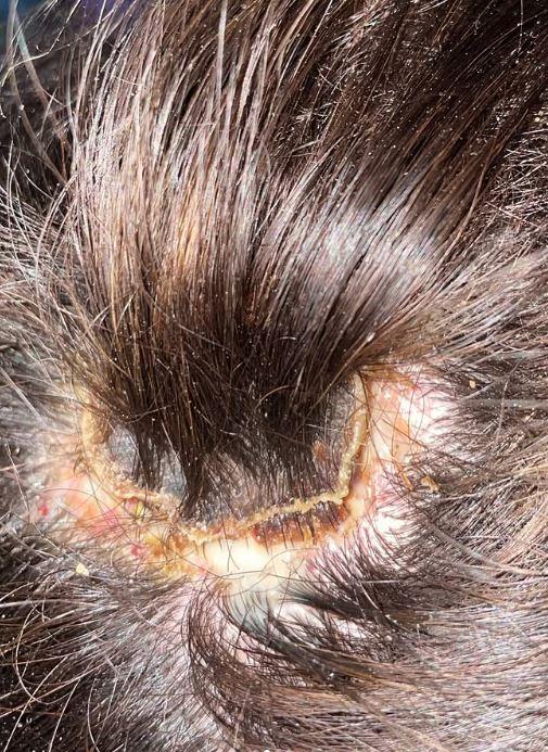 Quemadura en peluquería - Instagram