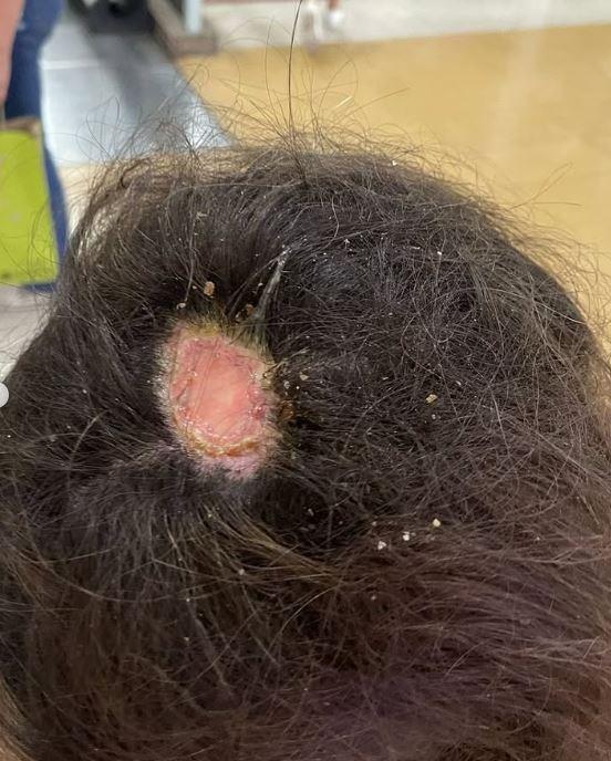 Clienta sufrió quemaduras en peluquería de Quilpué