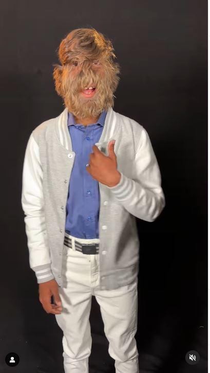 Joven recibió el Récord Guinness por tener la cara más peluda del mundo - Guinness