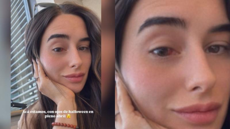 Instagram - Melina Noto y derrame ocular