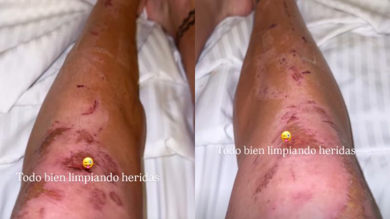 Instagram - Las lesiones por las que hospitalizaron a Raimundo Cerda