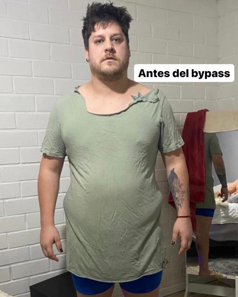 Elfi antes del bypass gástrico