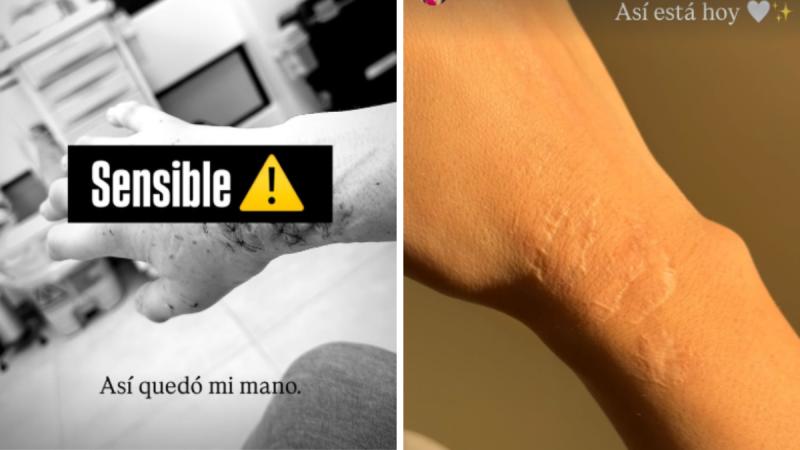 Emilia Dides muestra sus cicatrices tras accidente automovilístico - Instagram
