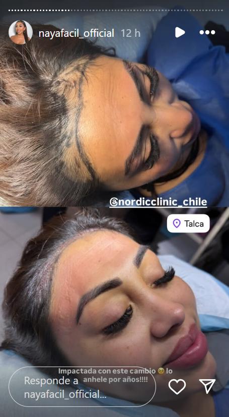 Naya Fácil mostró su impactante antes y después - Instagram
