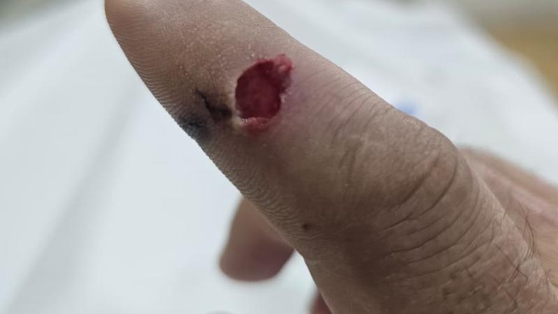 Gentileza - Así quedó el dedo de Cristián tras la mordedura de su gato