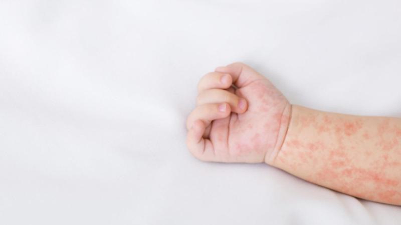 Enfermedad de boca, mano y pie - referencial freepik