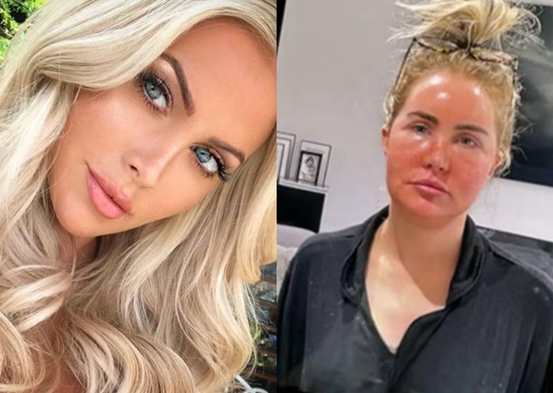 Influencer se hizo lifting facial y lo que encontraron en su cara dejó a los médicos en shock- RRSS