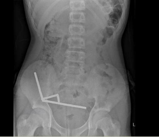Radiografía del niño que tragó los imanes (NZ Medical Journal) 