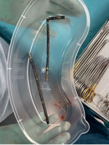 Cadena de imanes extraída de los intestinos del niño (NZ Medical Journal) - Temu