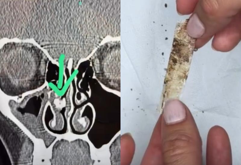 Lo que encontró en su nariz dejó a todos en shock: "estoy descubriendo a los 35 años cómo es respirar por las dos vías nasales" - RRSS