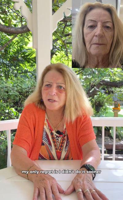 Captura @destinationbeauty.me - El cambio de mujer tras cirugía estética